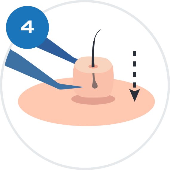 GRAFT
INSERTION